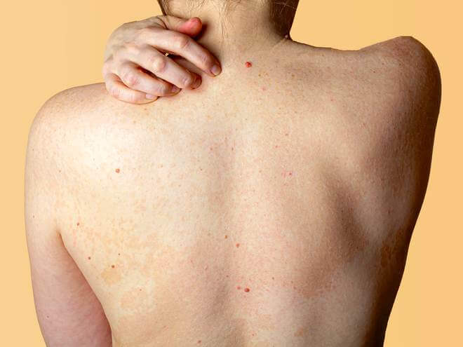pele ressecada dermatite