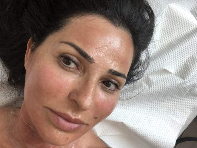 o que é melasma?