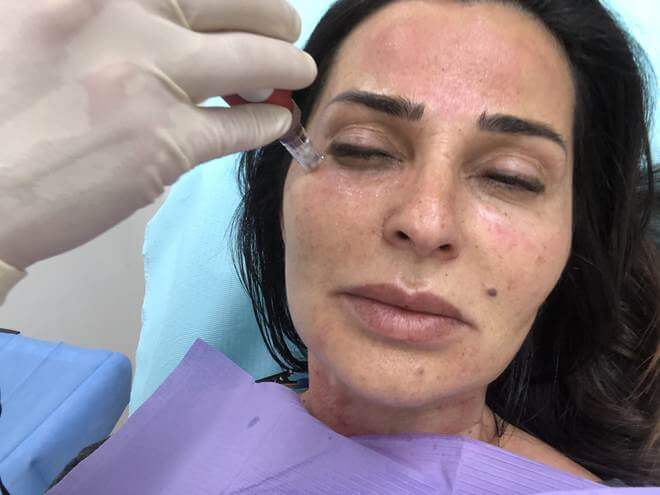 tratamento para melasma